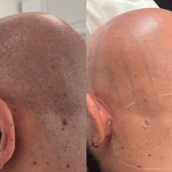 Scalp Laser Hair Removal