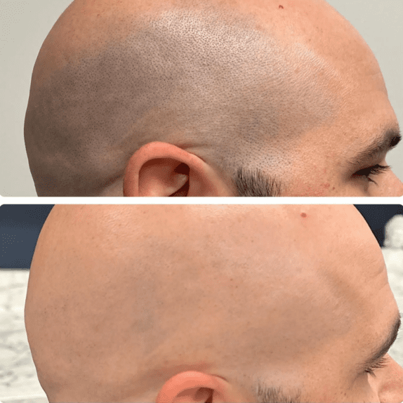 Scalp Laser Hair Removal