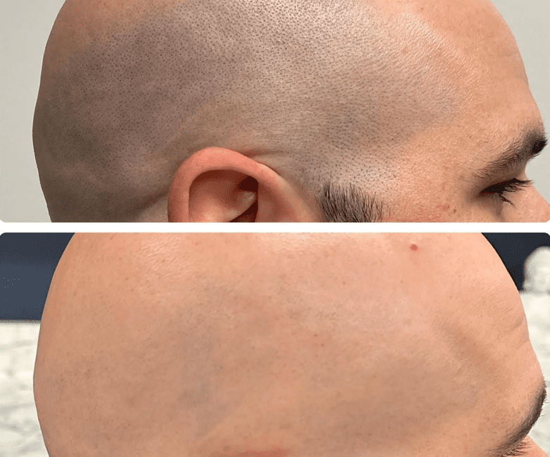 Scalp Laser Hair Removal