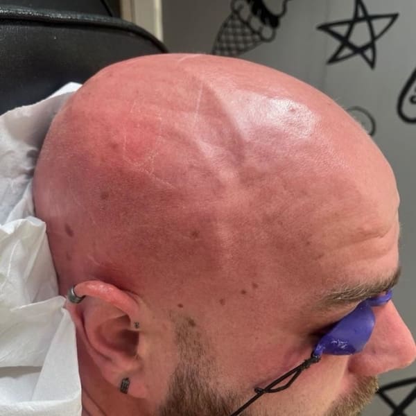 scalp hair removal