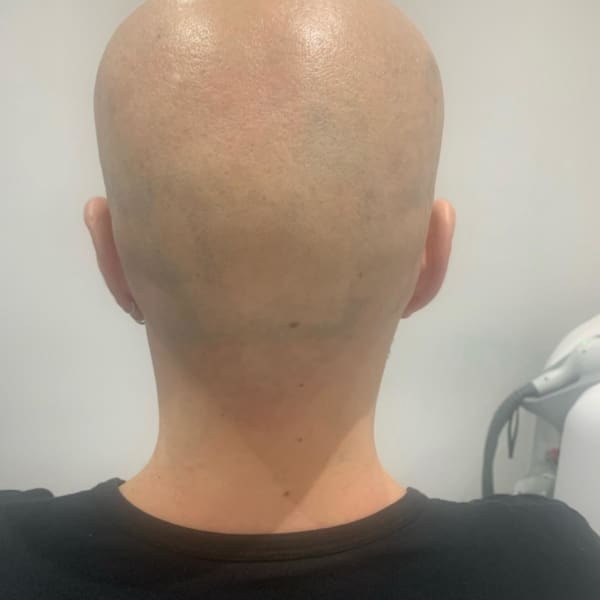 scalp hair removal