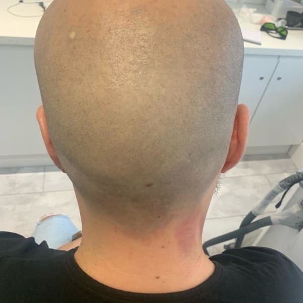scalp hair removal