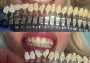 Teeth Whitening
