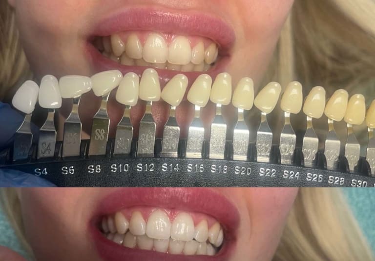 Teeth Whitening