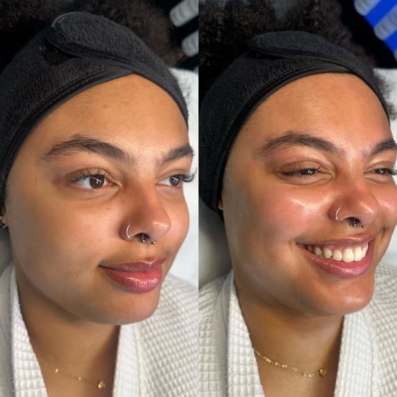 Skin Resurfacing Peels