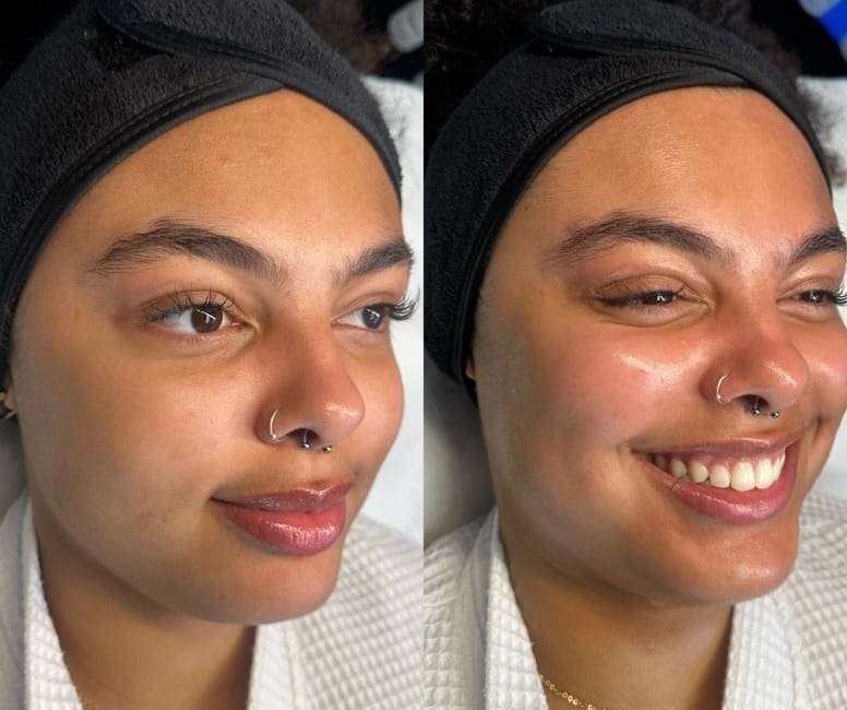 Skin Resurfacing Peels