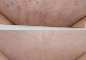 ingrown