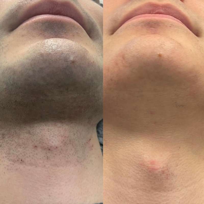 Neck and chin 3 sessions