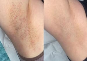 Laser Hair Removal