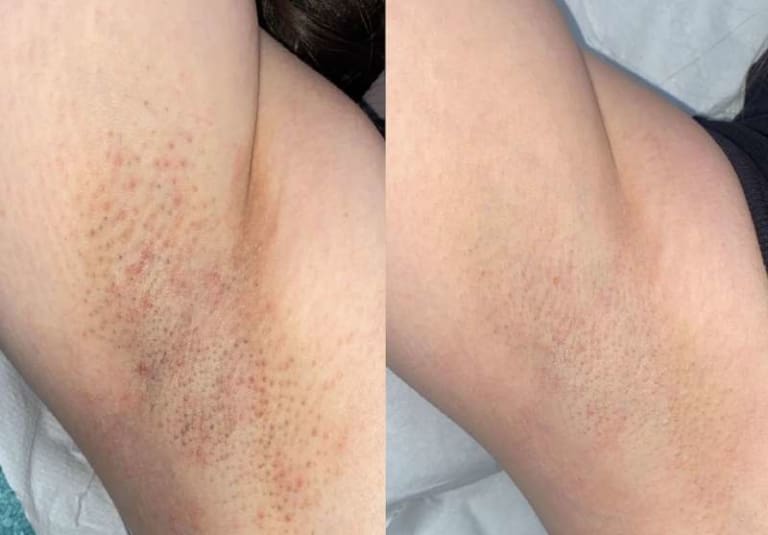 Laser Hair Removal