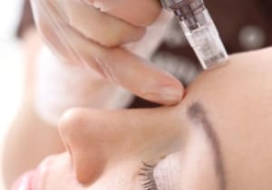 Micro Needling
