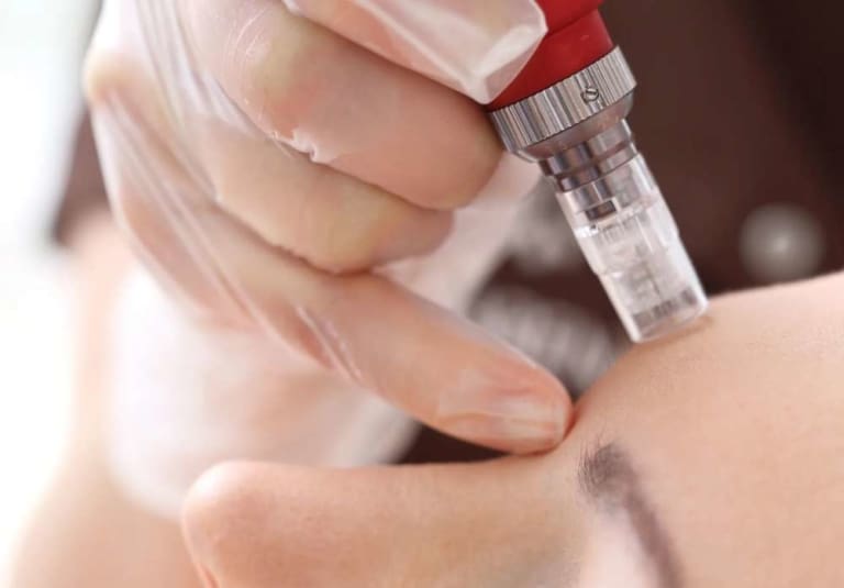 Micro Needling