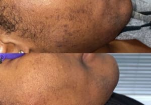Dark Hair Removal