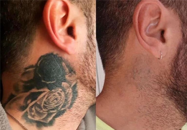 Tattoo Removal