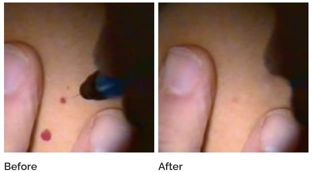 Thermavein