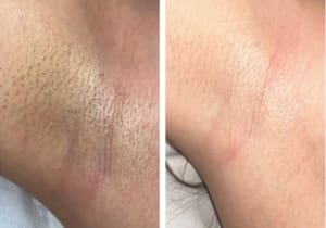 Skin Care No-Go’s for Laser Hair Removal